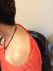 Is dry needling safe?