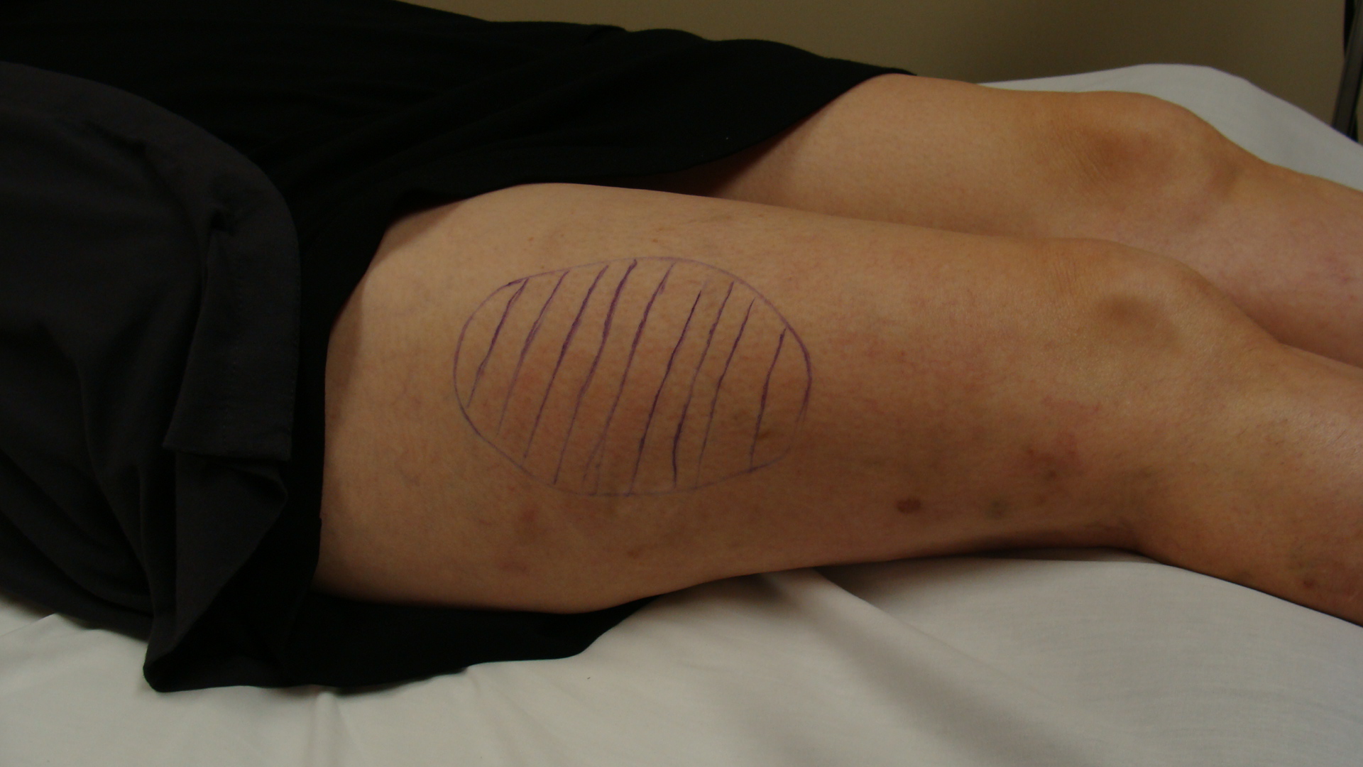 Treating meralgia paresthetica with acupuncture
